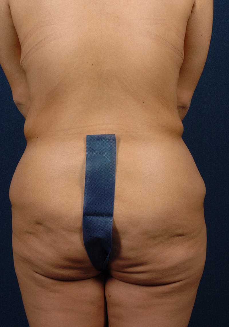 Lower Body Lift Before & After Gallery - Patient 9696233 - Image 7