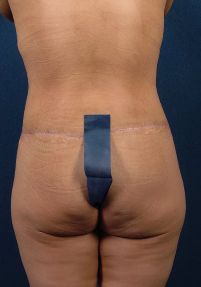 Lower Body Lift Before & After Gallery - Patient 9696233 - Image 8