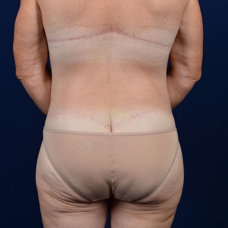 Upper Body Lift + Chest Wall Reshaping Before & After Gallery - Patient 9697440 - Image 4