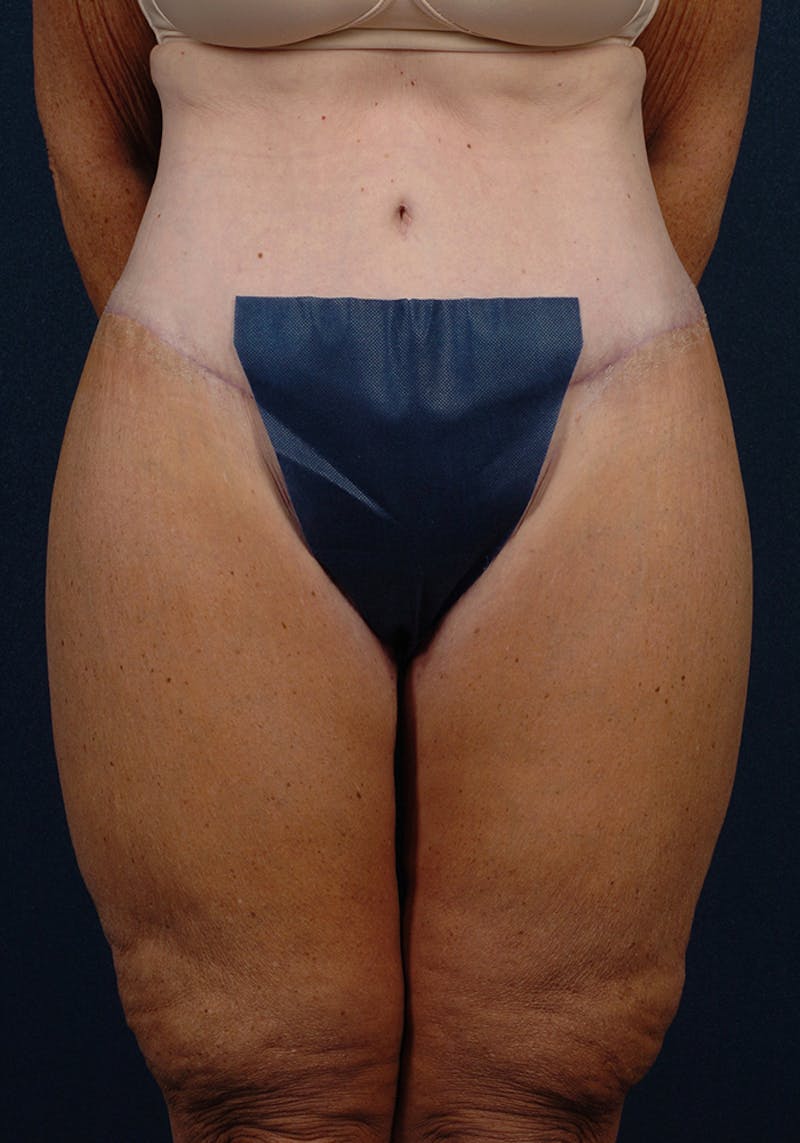 Thigh Lift Gallery - Patient 9697445 - Image 2