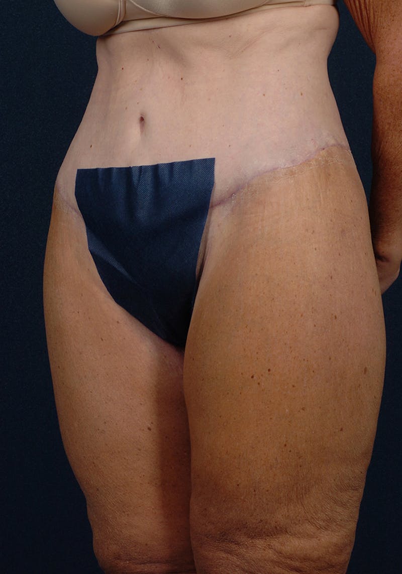 Thigh Lift Before & After Gallery - Patient 9697445 - Image 4