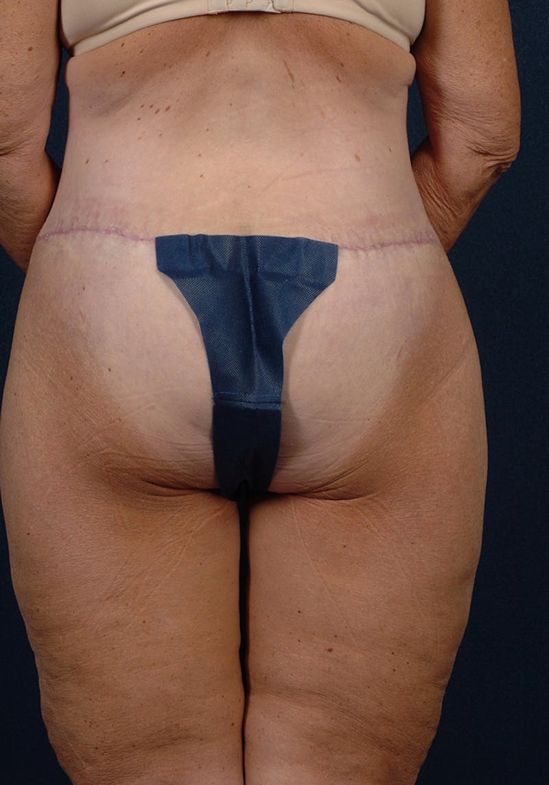 Thigh Lift Before & After Gallery - Patient 9697445 - Image 6