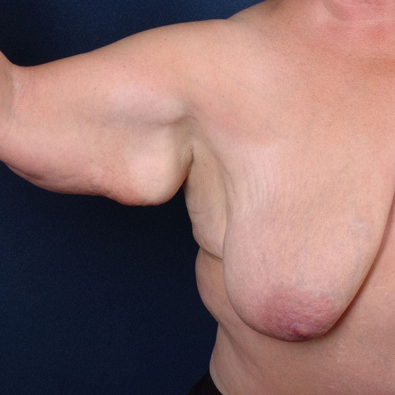 Upper Body Lift + Chest Wall Reshaping Before & After Gallery - Patient 9697449 - Image 1