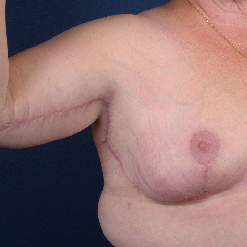 Upper Body Lift + Chest Wall Reshaping Before & After Gallery - Patient 9697449 - Image 2