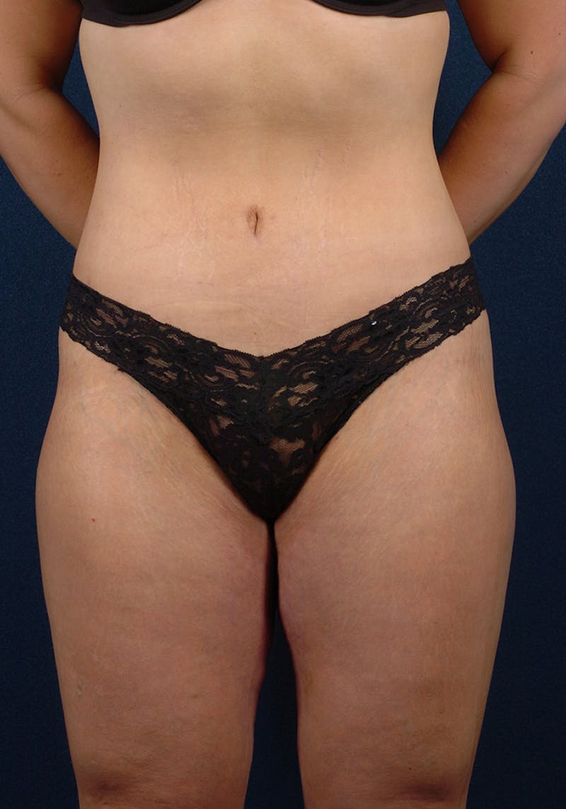 Thigh Lift Before & After Gallery - Patient 9697452 - Image 2