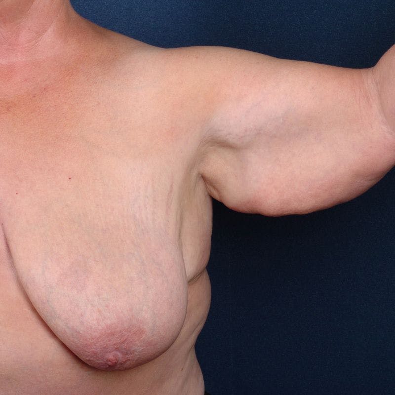 Upper Body Lift + Chest Wall Reshaping Before & After Gallery - Patient 9697449 - Image 3