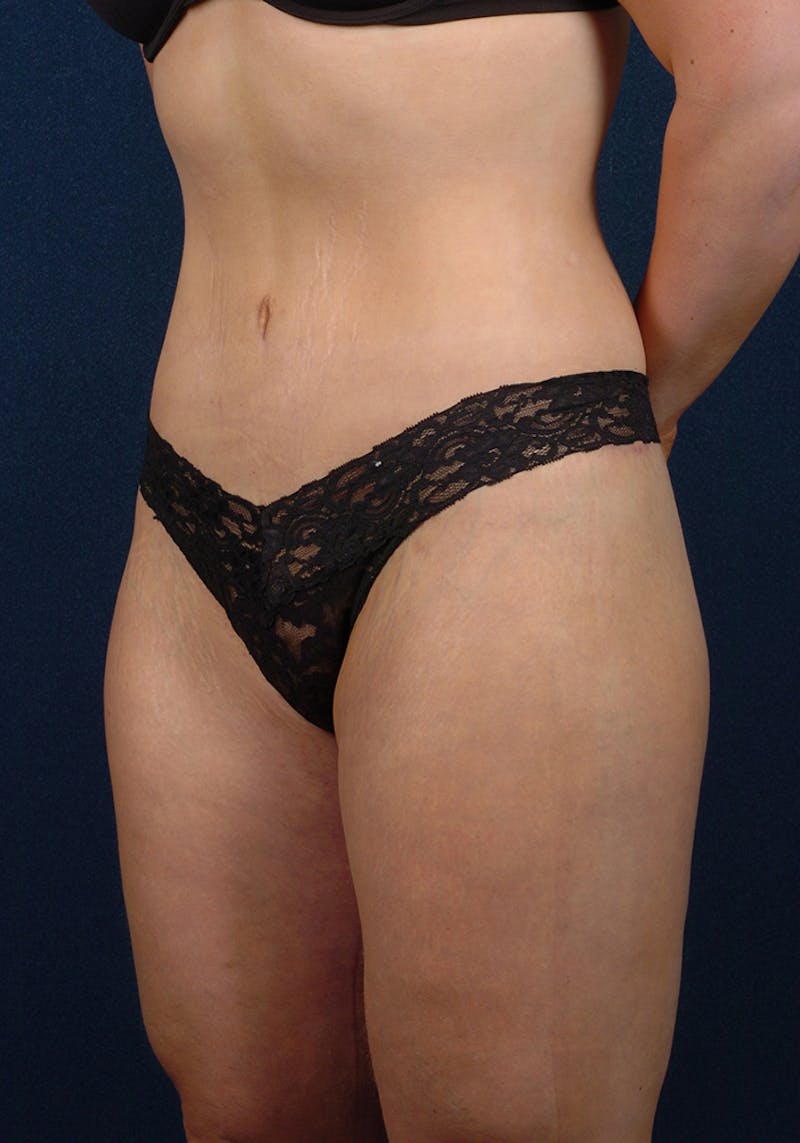 Thigh Lift Before & After Gallery - Patient 9697452 - Image 6