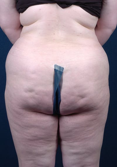 Lower Body Lift Before & After Gallery - Patient 9697589 - Image 7