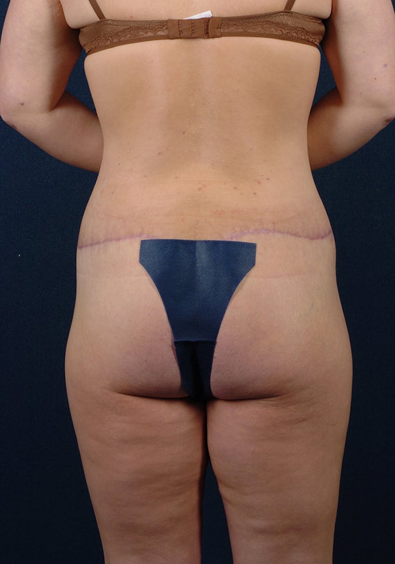Lower Body Lift Before & After Gallery - Patient 9697589 - Image 8