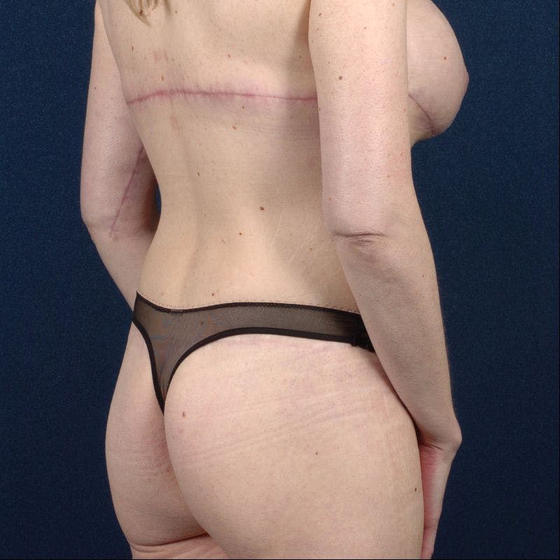 Upper Body Lift + Chest Wall Reshaping Before & After Gallery - Patient 9697590 - Image 6