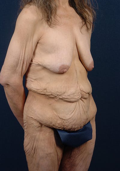 Lower Body Lift Before & After Gallery - Patient 9697786 - Image 5