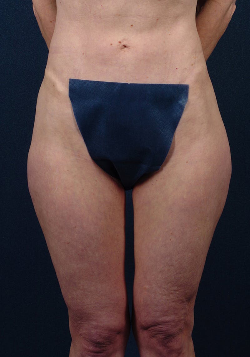 Thigh Lift Before & After Gallery - Patient 9697791 - Image 1