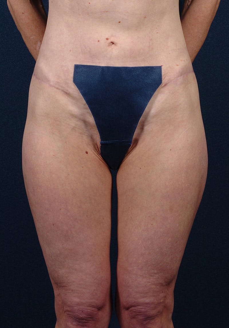 Thigh Lift Before & After Gallery - Patient 9697791 - Image 2