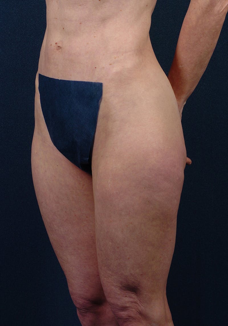 Thigh Lift Before & After Gallery - Patient 9697791 - Image 3
