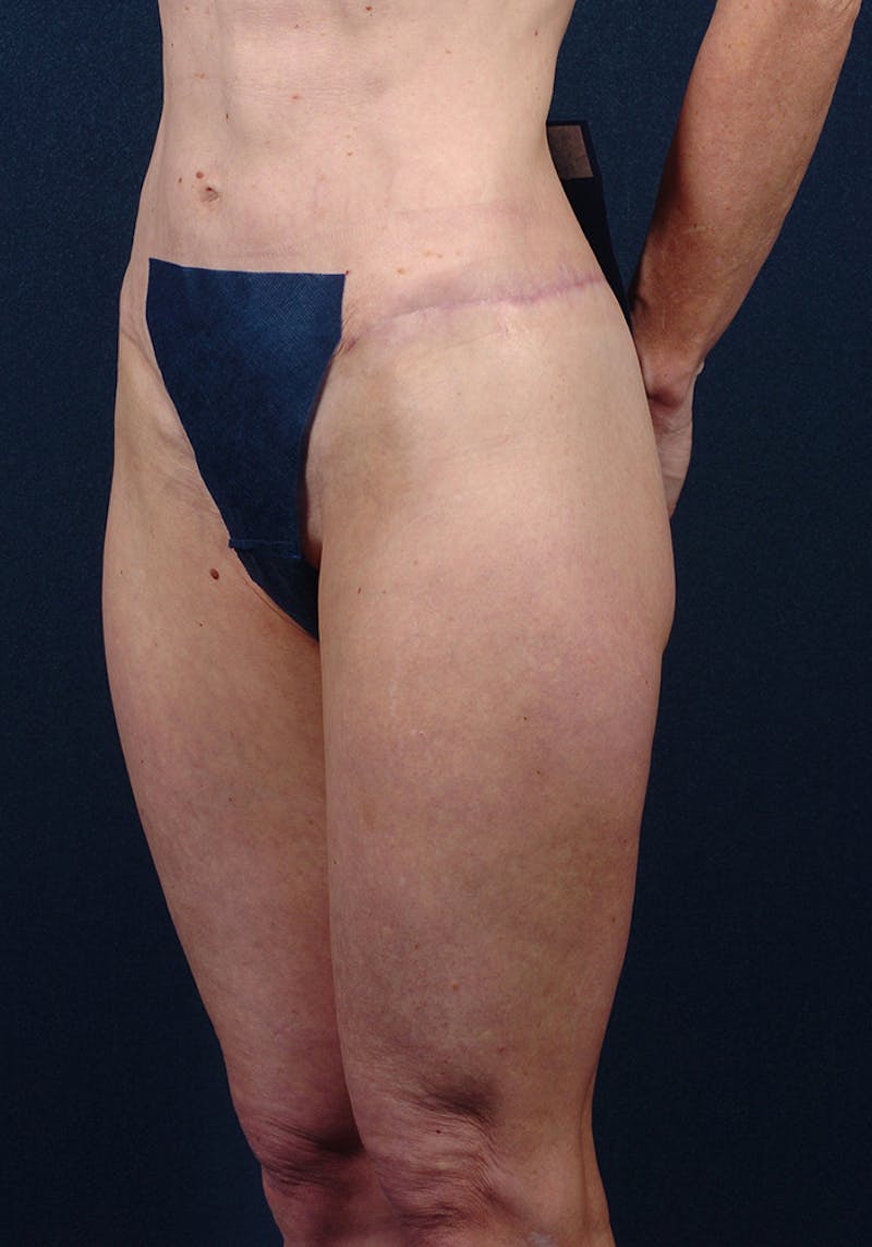 Thigh Lift Before & After Gallery - Patient 9697791 - Image 4
