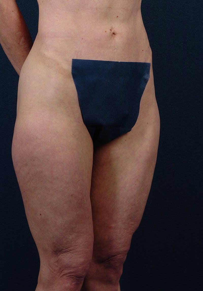 Thigh Lift Before & After Gallery - Patient 9697791 - Image 5