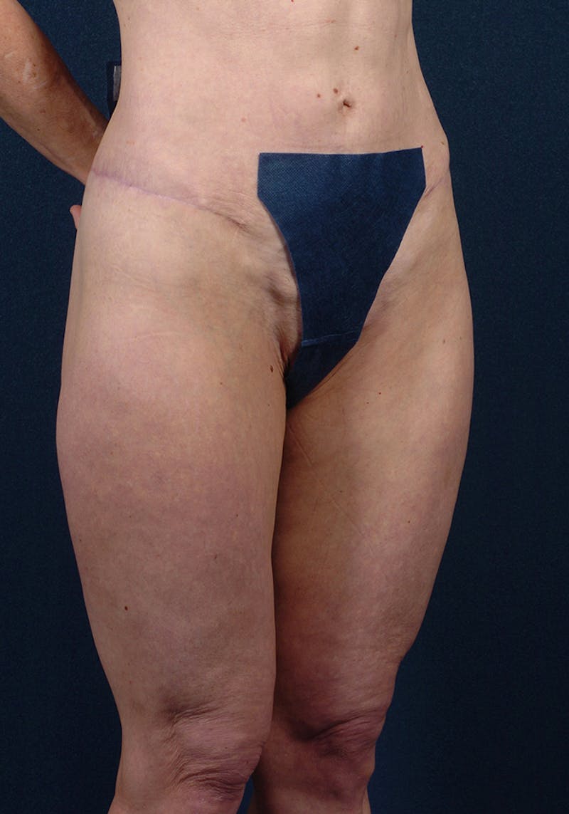Thigh Lift Before & After Gallery - Patient 9697791 - Image 6