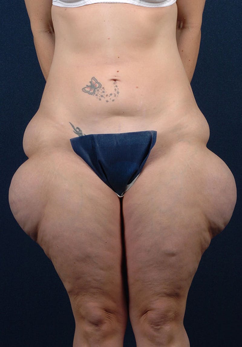 Thigh Lift Before & After Gallery - Patient 9697798 - Image 1