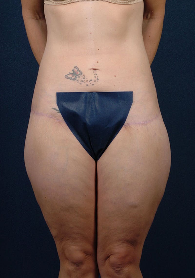 Thigh Lift Before & After Gallery - Patient 9697798 - Image 2