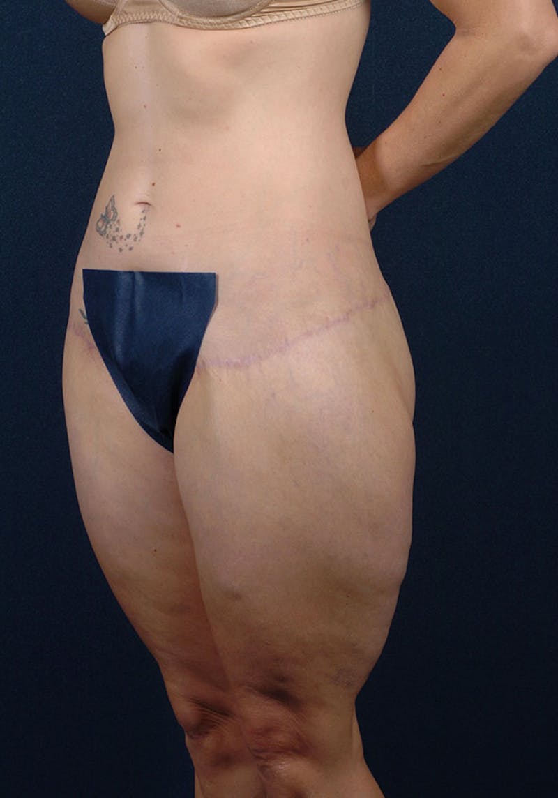 Thigh Lift Gallery - Patient 9697798 - Image 4