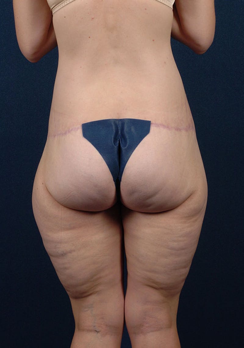 Thigh Lift Before & After Gallery - Patient 9697798 - Image 6