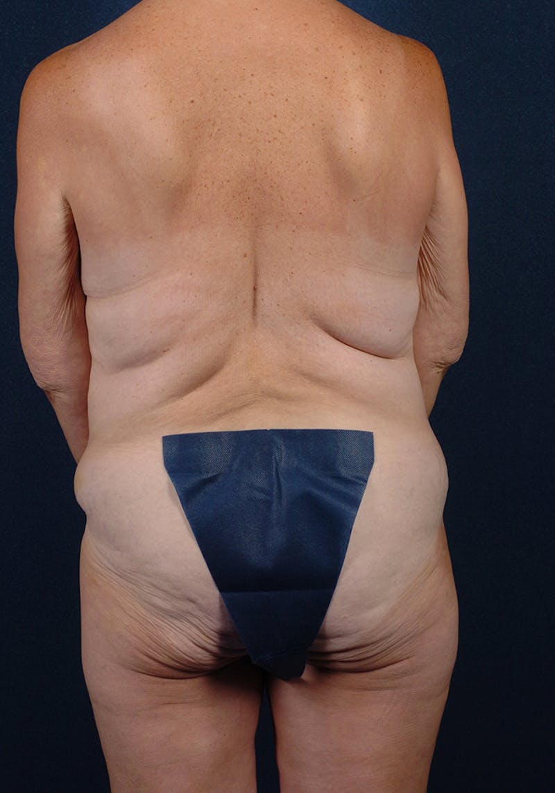 Lower Body Lift Before & After Gallery - Patient 9697801 - Image 7