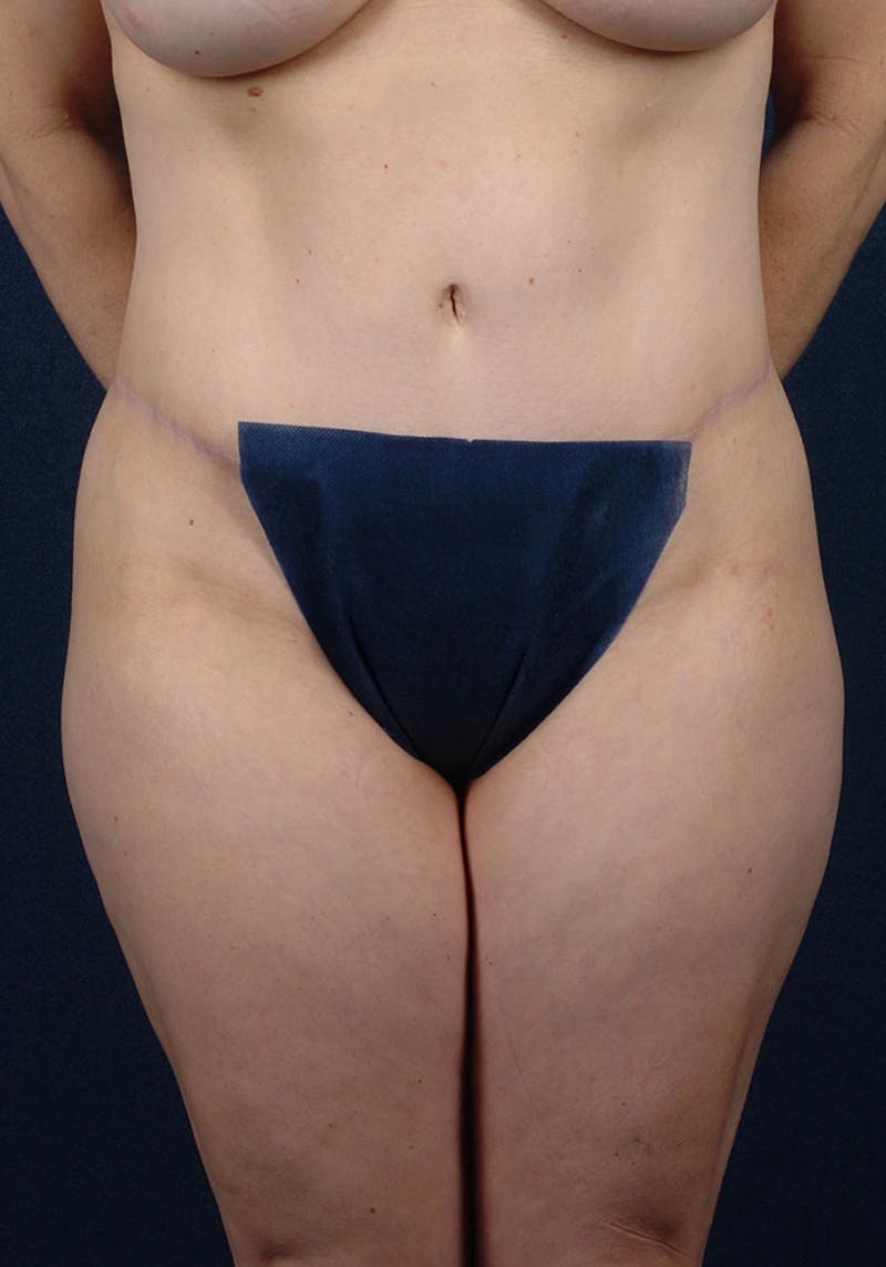 Thigh Lift Gallery - Patient 9697802 - Image 2