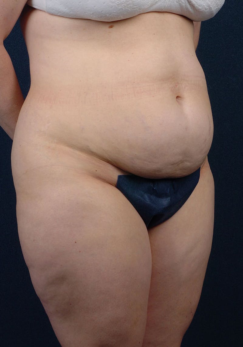Thigh Lift Before & After Gallery - Patient 9697802 - Image 3