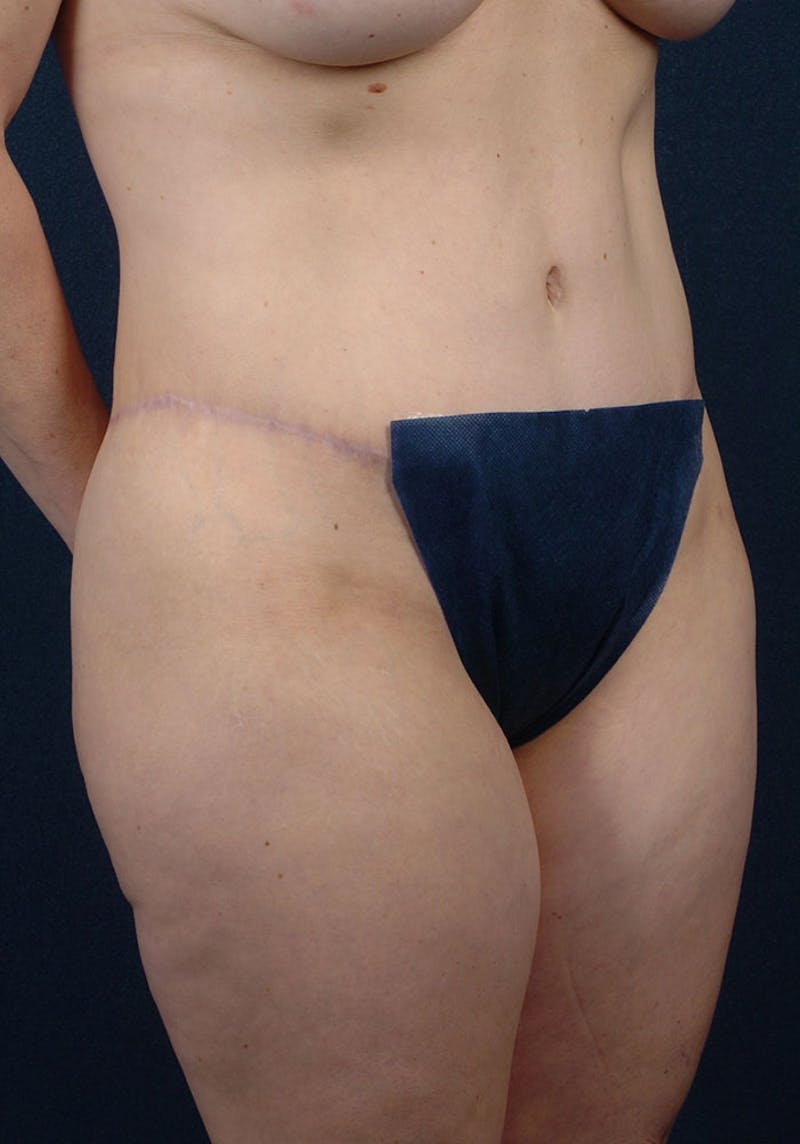 Thigh Lift Before & After Gallery - Patient 9697802 - Image 4