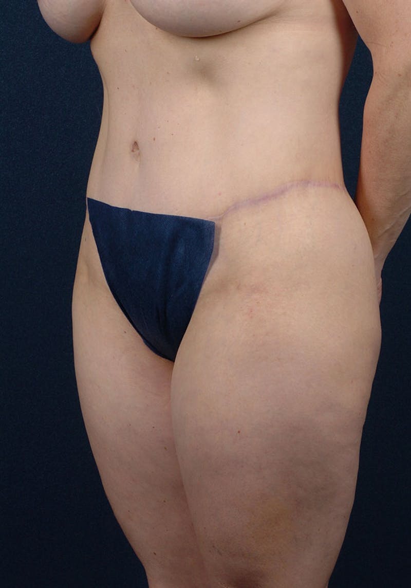 Thigh Lift Before & After Gallery - Patient 9697802 - Image 6