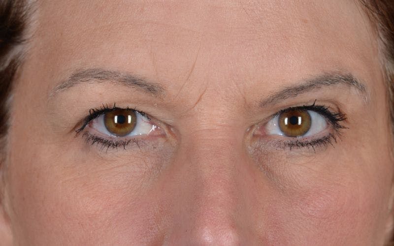 Blepharoplasty Before & After Gallery - Patient 9697805 - Image 1