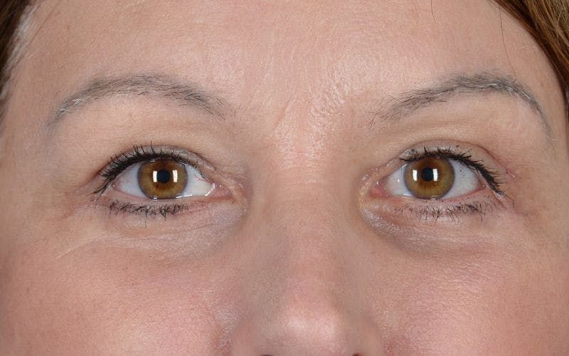 Blepharoplasty Before & After Gallery - Patient 9697805 - Image 2