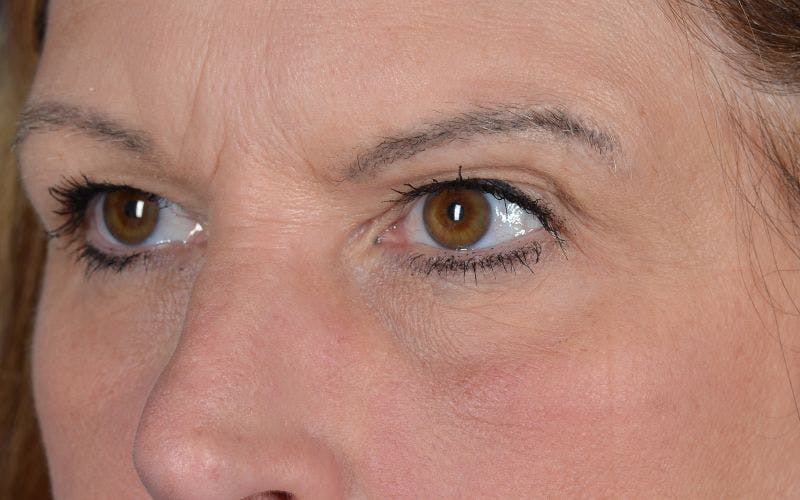 Blepharoplasty Before & After Gallery - Patient 9697805 - Image 3
