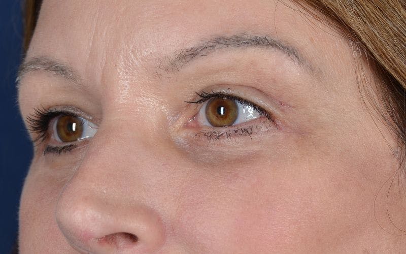 Blepharoplasty Before & After Gallery - Patient 9697805 - Image 4