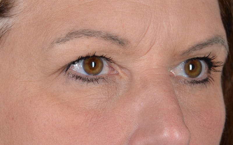 Blepharoplasty Before & After Gallery - Patient 9697805 - Image 5