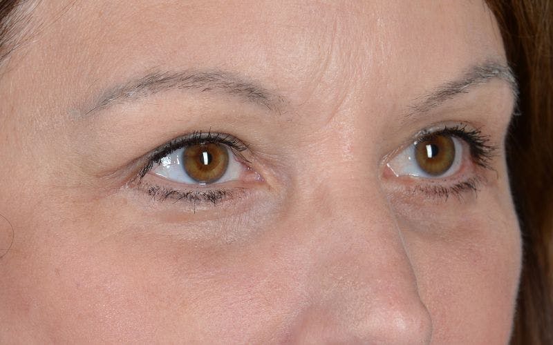Blepharoplasty Before & After Gallery - Patient 9697805 - Image 6