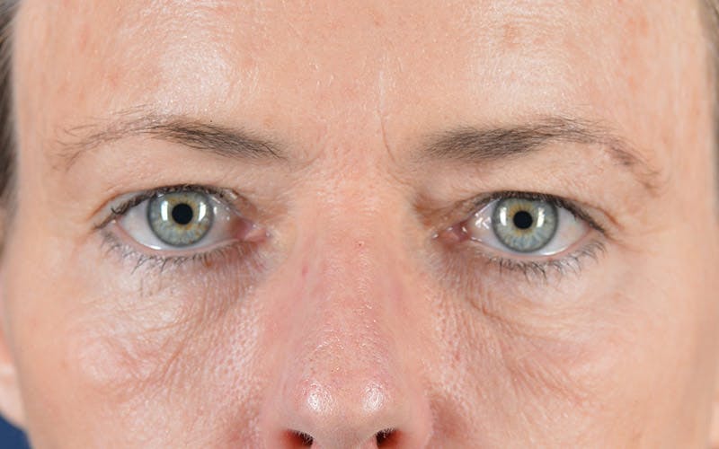 Blepharoplasty Before & After Gallery - Patient 9697979 - Image 1