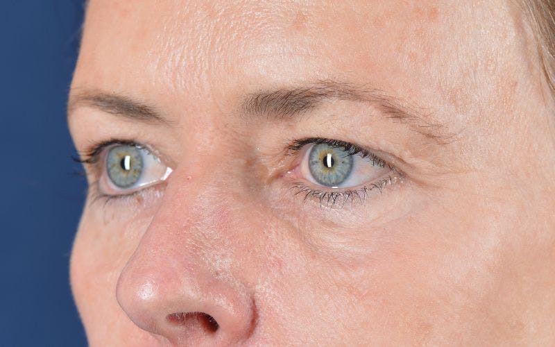 Blepharoplasty Before & After Gallery - Patient 9697979 - Image 3
