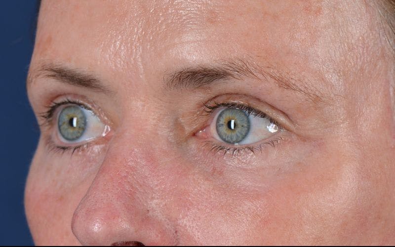 Blepharoplasty Before & After Gallery - Patient 9697979 - Image 4