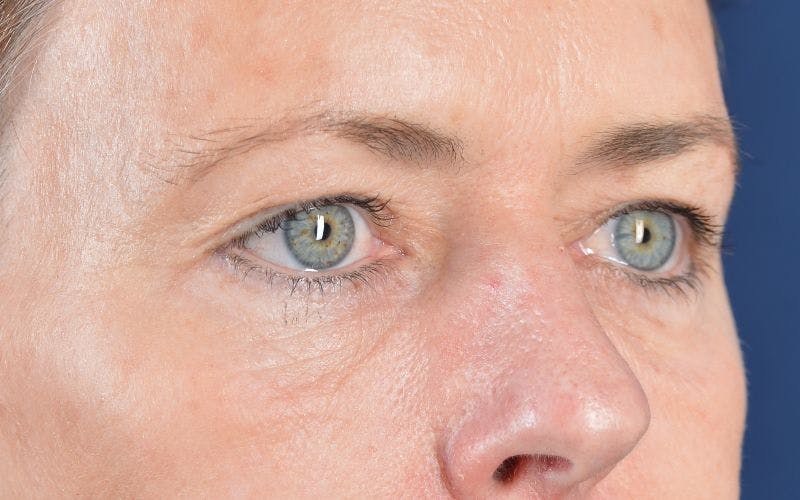 Blepharoplasty Before & After Gallery - Patient 9697979 - Image 5