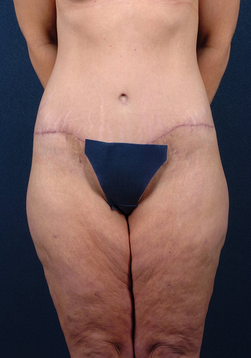 Lower Body Lift Before & After Gallery - Patient 9698214 - Image 2