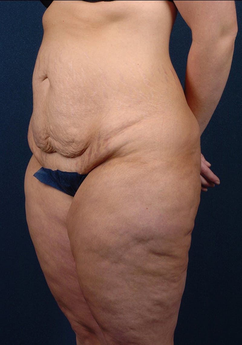 Lower Body Lift Before & After Gallery - Patient 9698214 - Image 3