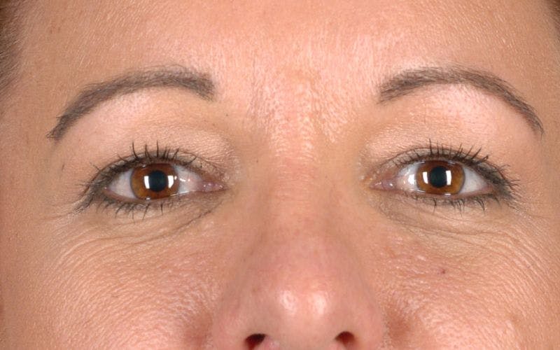 Blepharoplasty Before & After Gallery - Patient 9698213 - Image 1