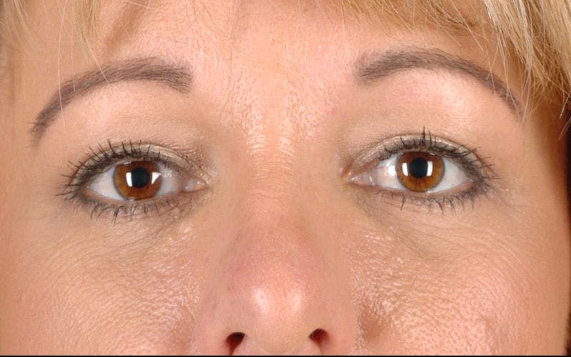 Blepharoplasty Before & After Gallery - Patient 9698213 - Image 2