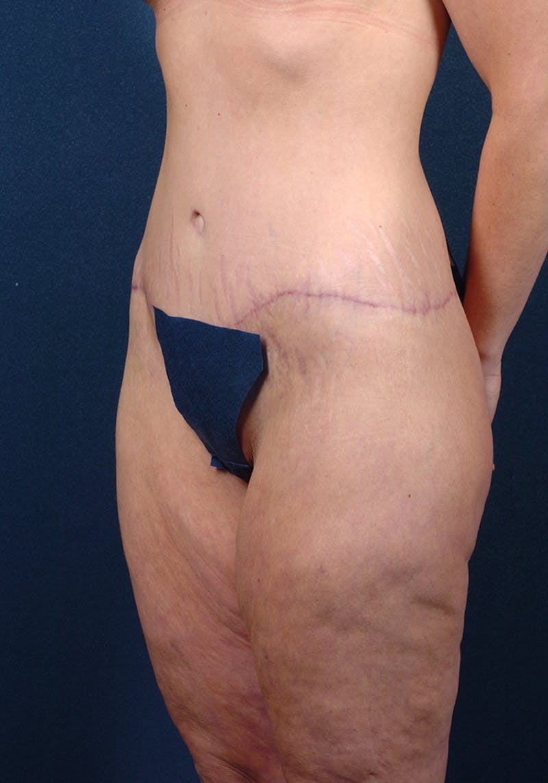 Lower Body Lift Before & After Gallery - Patient 9698214 - Image 4