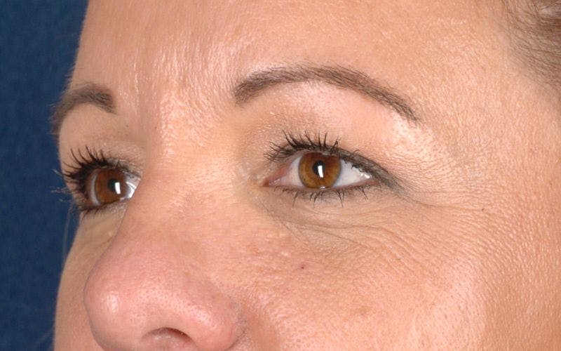 Blepharoplasty Before & After Gallery - Patient 9698213 - Image 3
