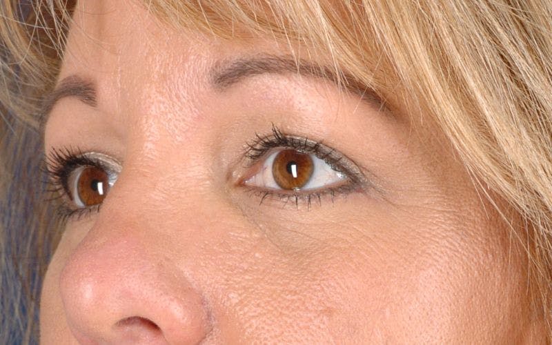 Blepharoplasty Before & After Gallery - Patient 9698213 - Image 4