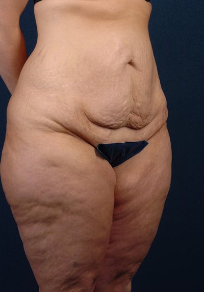 Lower Body Lift Before & After Gallery - Patient 9698214 - Image 5