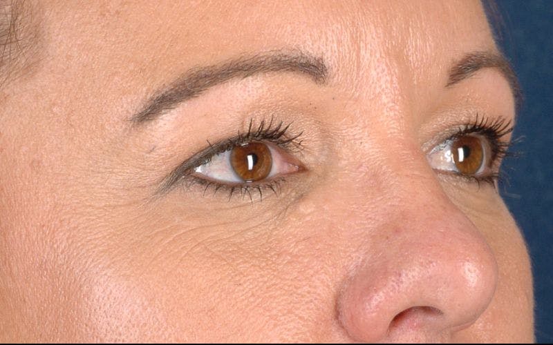 Blepharoplasty Before & After Gallery - Patient 9698213 - Image 5