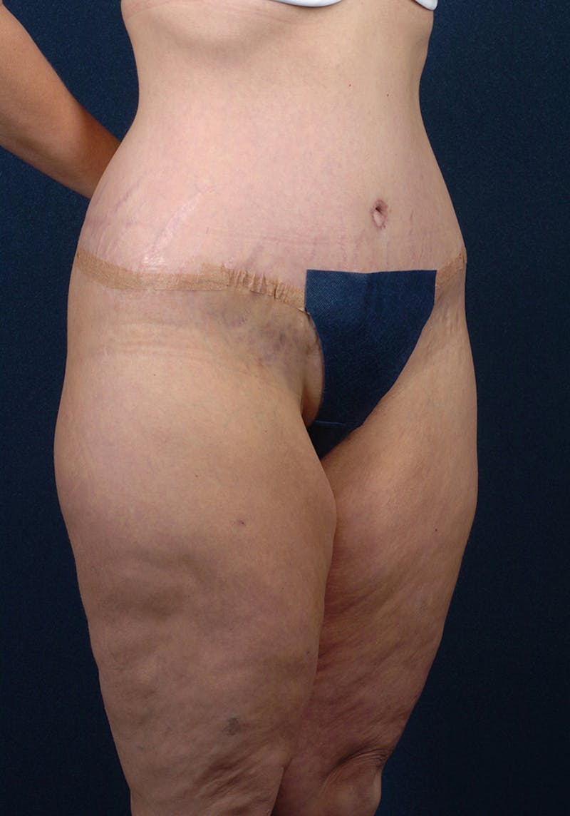 Lower Body Lift Before & After Gallery - Patient 9698214 - Image 6